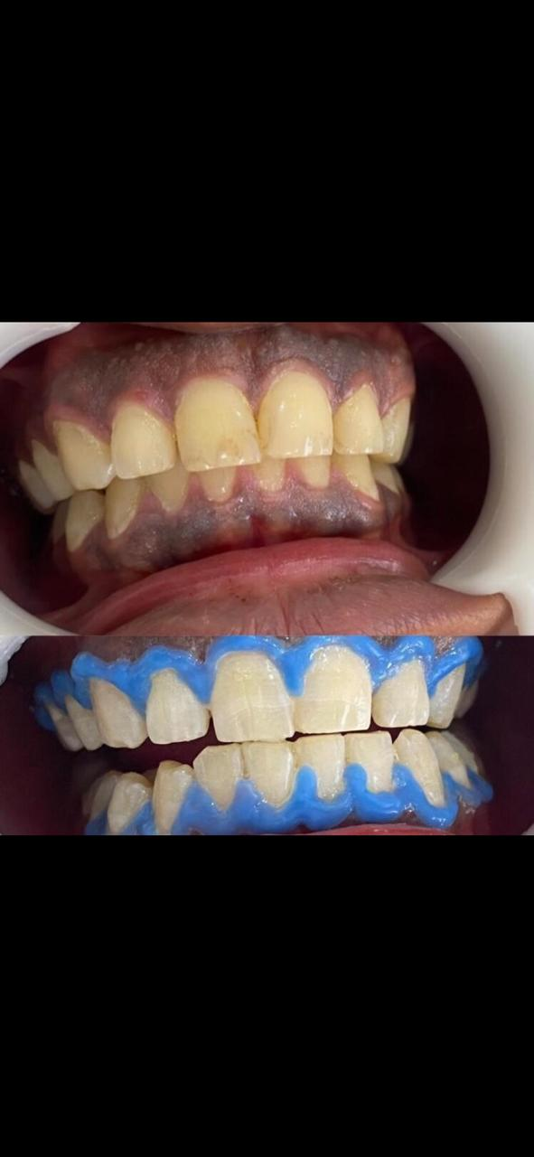 صورتان لحالة تبييض داخل العيادة تظهر إحداهما حاجز حماية اللثة الأزرق