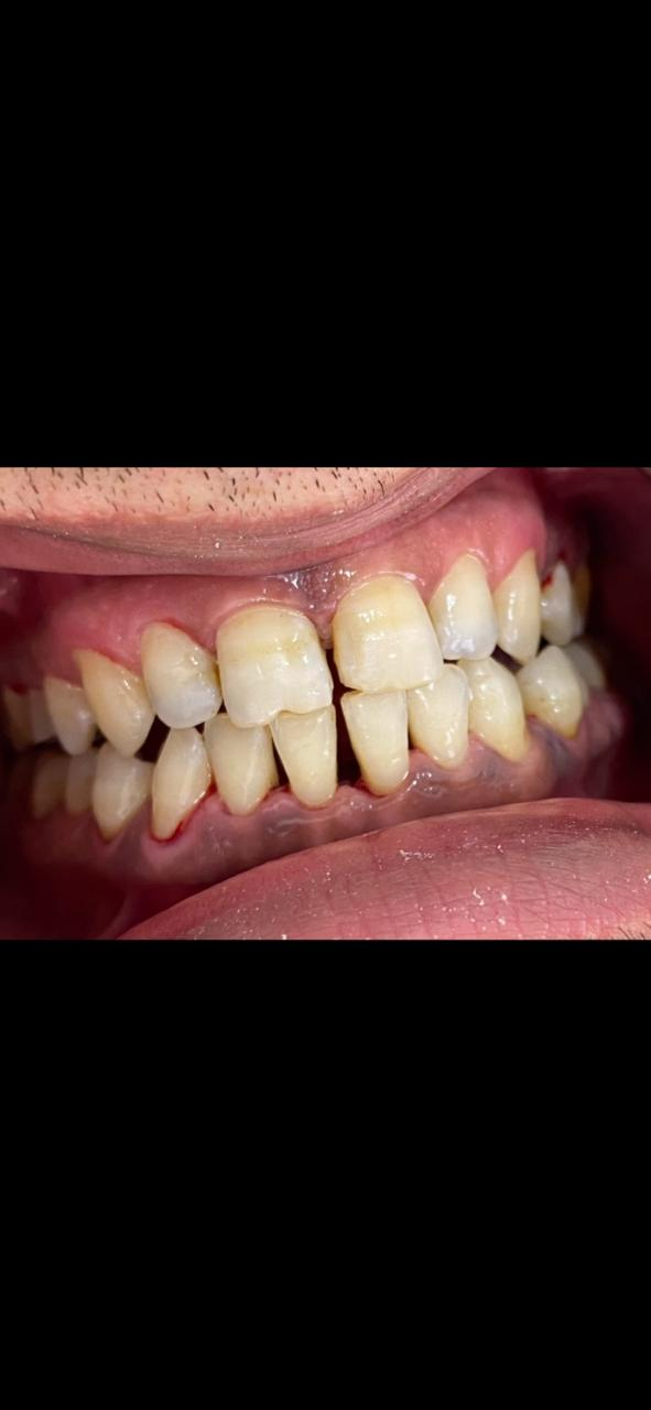 مظهر الأسنان الأمامية بعد إزالة الترسبات وفق تسلسل الصور المرسل من العيادة