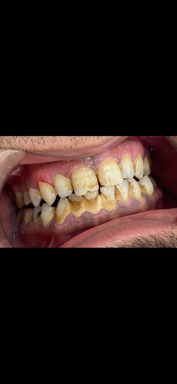 ترسبات كثيفة ظاهرة حول الأسنان الأمامية قبل التنظيف