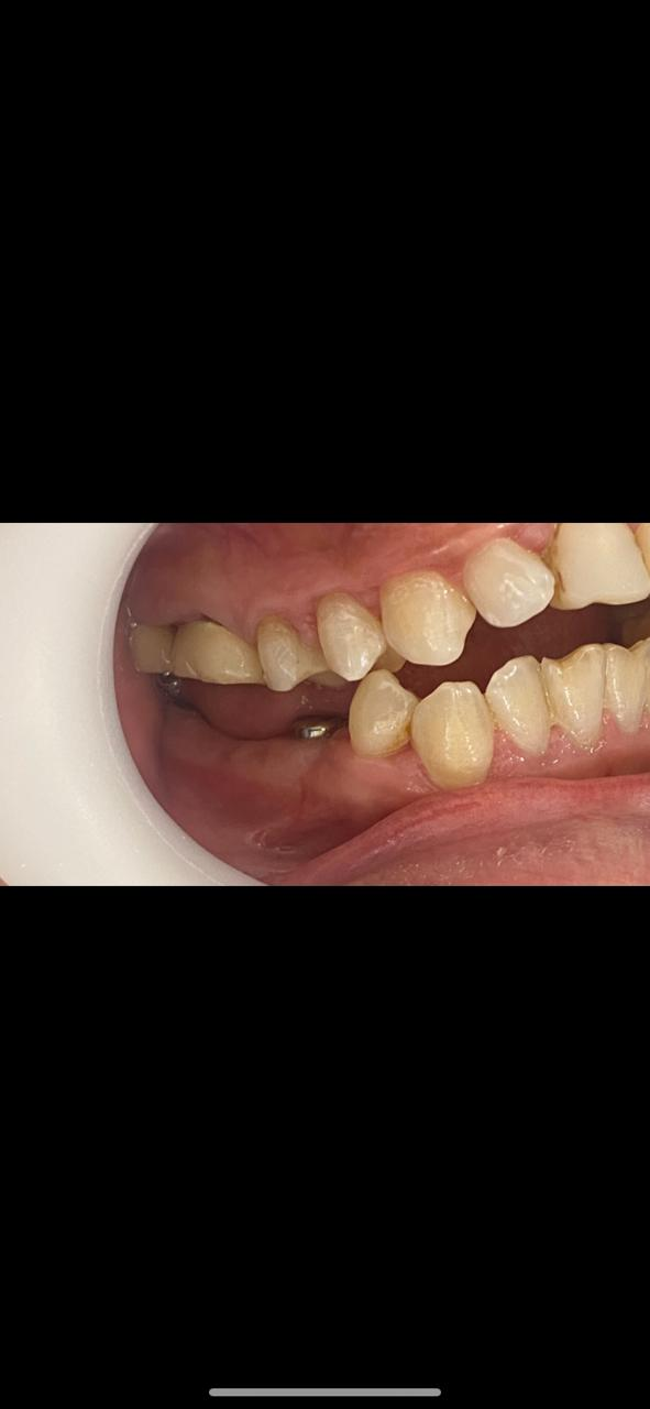 منطقة أسنان خلفية سفلية مع ظهور جزء معدني في موضع الغرسة قبل التركيب