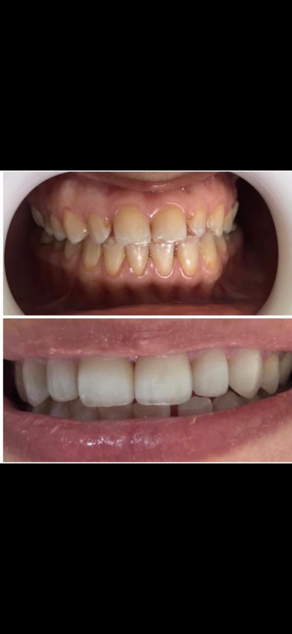 مقارنة لابتسامة قبل وبعد القشور التجميلية، توضح تغيّر اللون والشكل الظاهر للأسنان الأمامية
